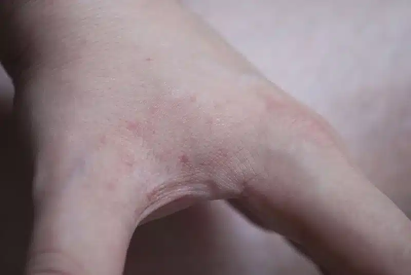 Close-up of skin irritation on hand