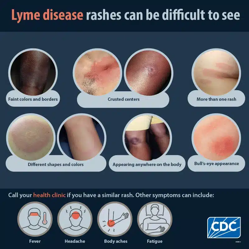 Different types of Lyme disease rashes